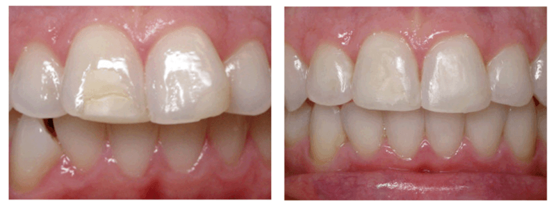 Before and after Invisalign in Liberty Lake, WA