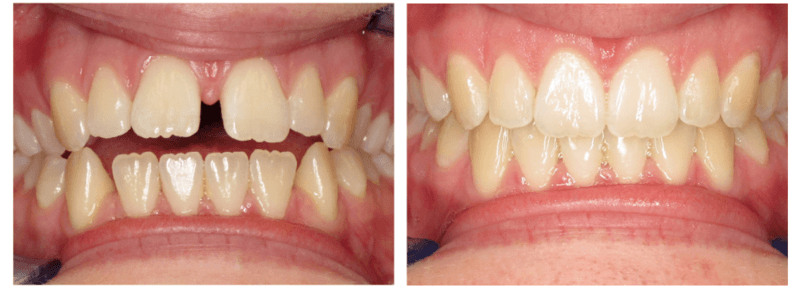 Before and after Invisalign in Yakima, WA