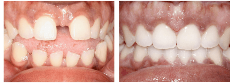 Before & After Invisalign Clear Aligners in Liberty Lake, Yakima, & Ellensburg, WA