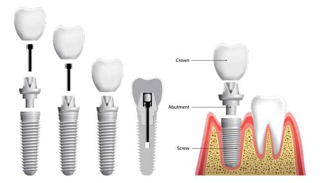 Dental Implant graphic diagram